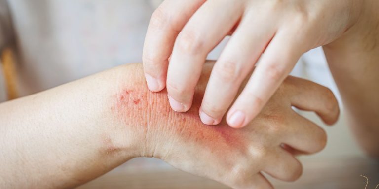 Tick Bite Treatment Middleton, MA